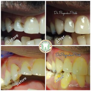 Dental Fillings