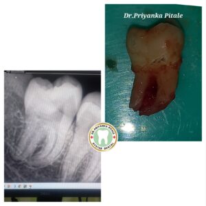 Wisdom tooth extraction