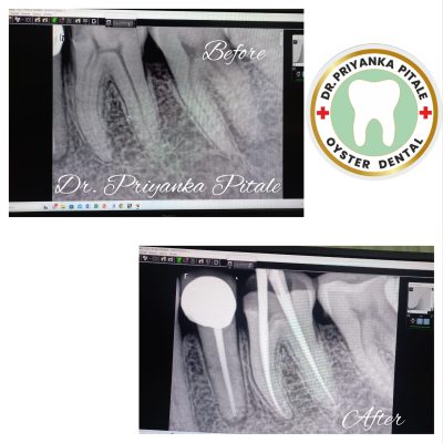 Root_canal1 root canal